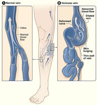 Diagram comparing a normal vein and a varicose vein