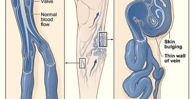 Diagram comparing a normal vein and a varicose vein