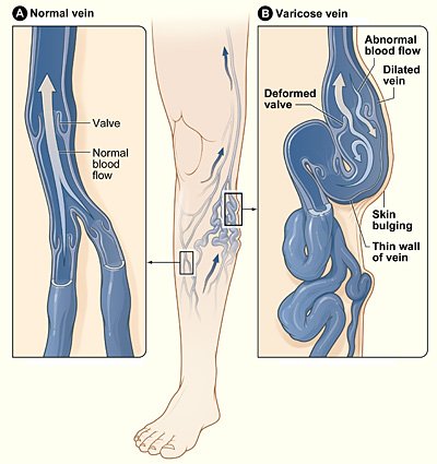 Diagram comparing a normal vein and a varicose vein